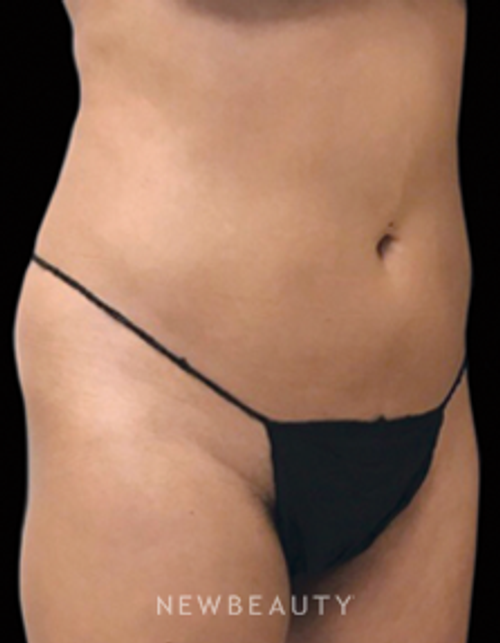 Dr. Janet Allenby - CoolSculpting - After