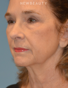 Dr. Henry Mentz - Facelift - Before