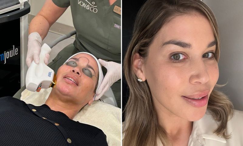 VISIA analysis during and after