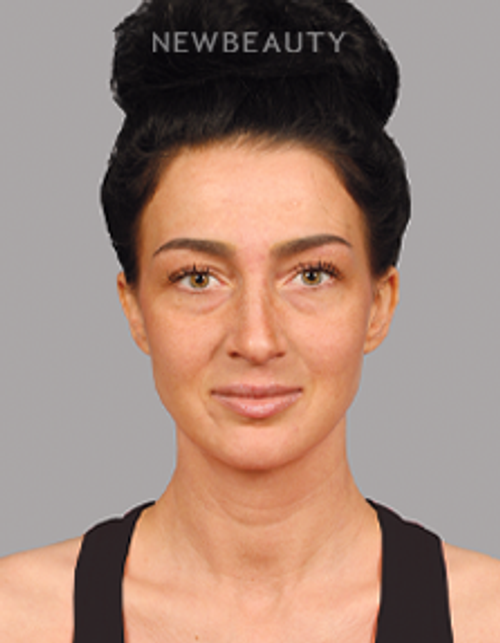 Dr. Raman Mahabir - Lower Eyelid - Before