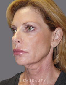 Dr. Andrew Ordon Facelift, Necklift, Chemical Peel, Injectables & Fillers, Lasers - Before