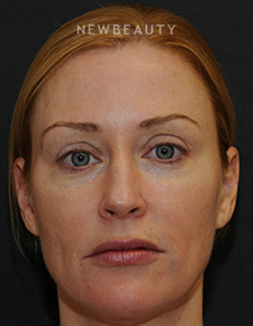 Dr. Janet Allenby - Injectables & Fillers - After