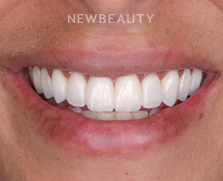 Dr. Husam Almunajed - Smile Makeover - 41358035 - After