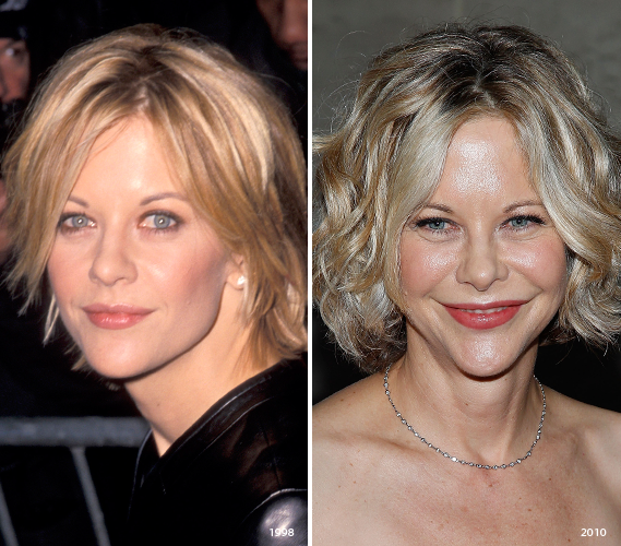 Meg Ryan Over-Injected Celebrities