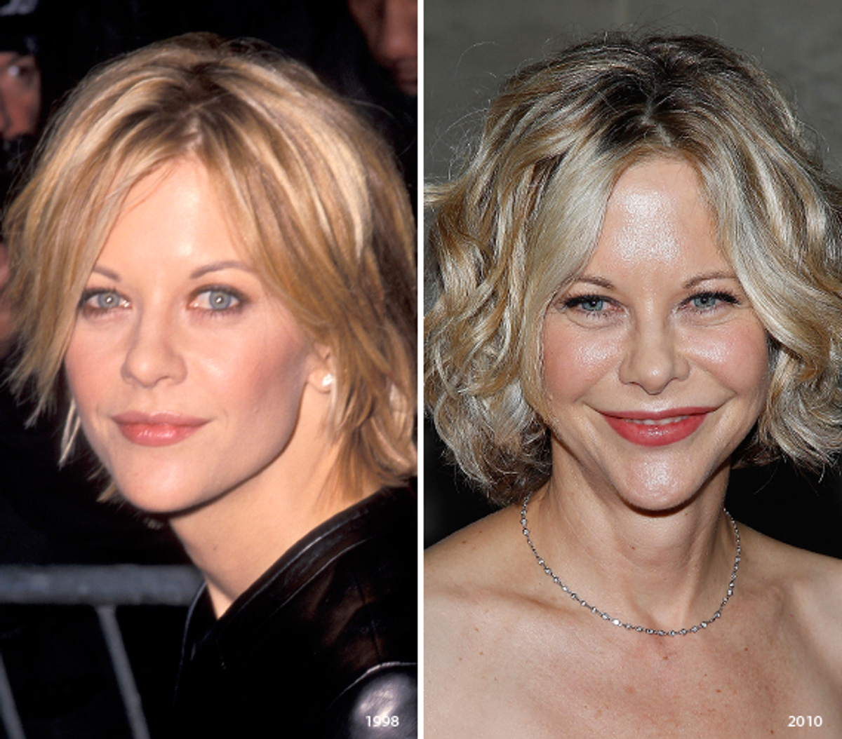 Meg Ryan Over-Injected Celebrities