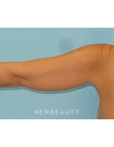 Dr. Sean Simon - Smartlipo - Before