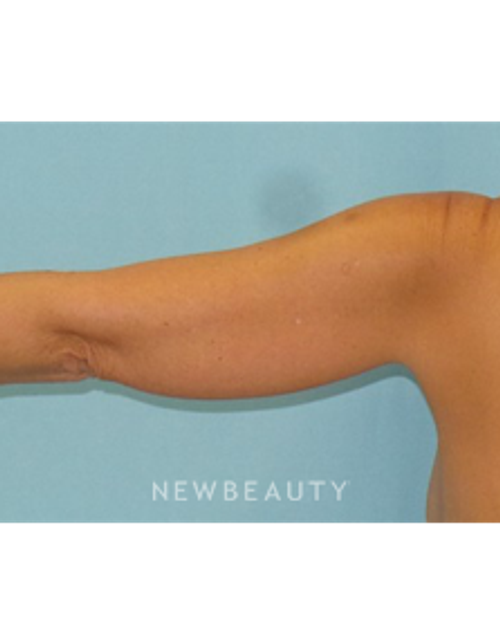 Dr. Sean Simon - Smartlipo - Before