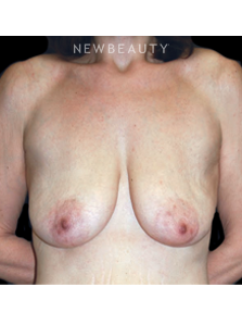 Dr. Roman Rayham - Breast Lift - Before