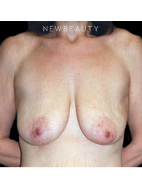 Dr. Roman Rayham - Breast Lift - Before