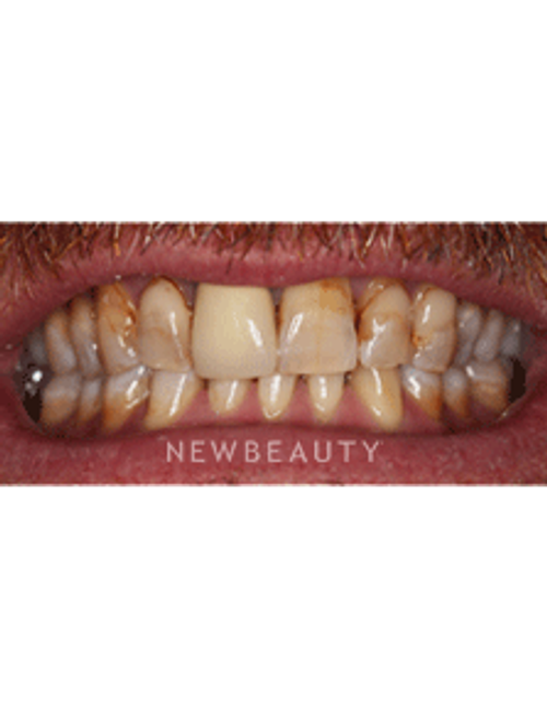 Dr. Neal Patel Smile Makeover - Before
