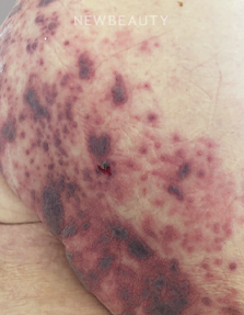 Dr. Anna Chacon - Calciphylaxis - 34279110 - Before