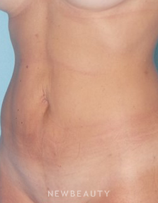 Dr. Sean Simon - Smartlipo - After