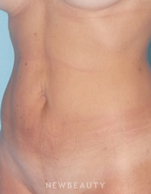 Dr. Sean Simon - Smartlipo - After