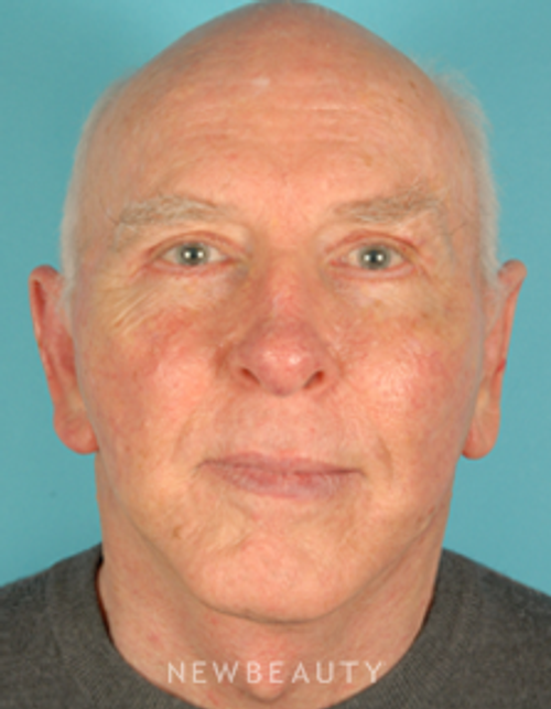 Dr. David Kim Blepharoplasty, Facelift, Necklift, Otoplasty - After
