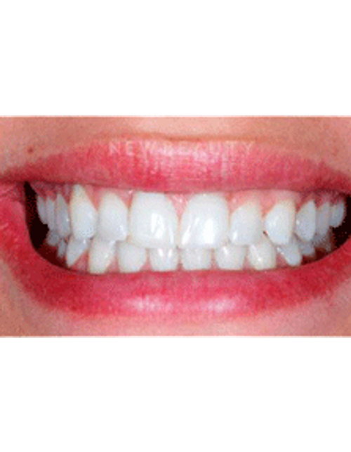 Dr. Guy Lewis Veneers - Before