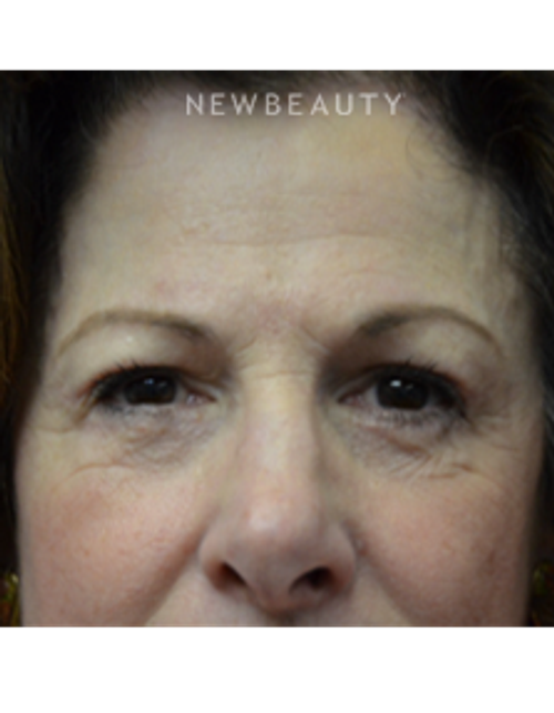 Dr. B. Aviva Preminger - Youthful Look - After