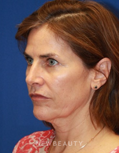 Dr. Dilip Madnani - Facelift - Before