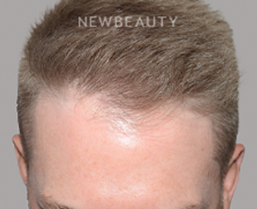 Dr. Jeffrey Epstein - Hair Transplant - 46167913 - After