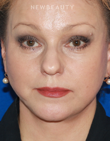 Dr. Konstantin Vasyukevich - Facelift - After