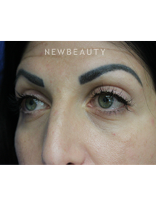 Dr. Joseph Russo - A Fresh Look (Eye EBG) - After