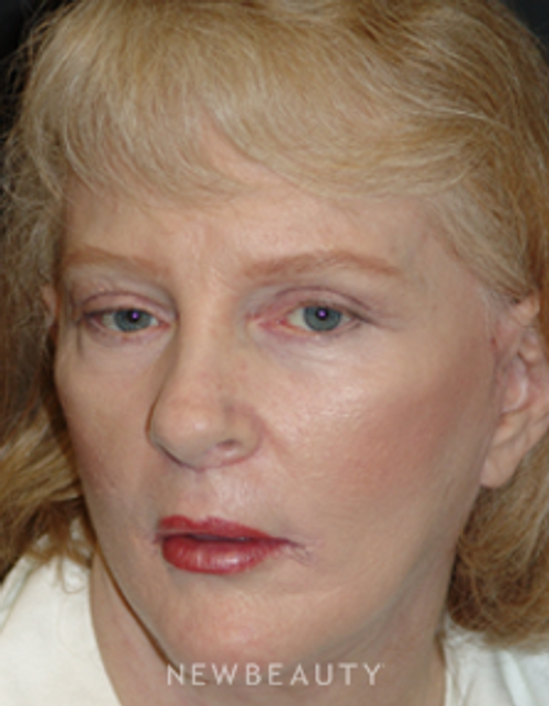 Dr. Mokhtar Asaadi Eyelid Lift, Facelift, Necklift - After