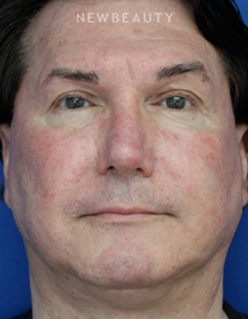 Dr. Joseph Russo - Natural-Looking Results (Face EBG) - Before