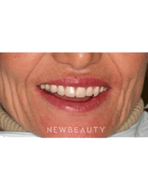 Dr. Neal Patel Smile Makeover - After