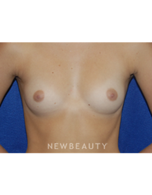 Dr. Bradley Bengtson - Breast Augmentation - Before