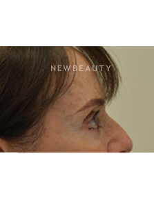 Dr. Julie Russak - Liquid Facelift - After