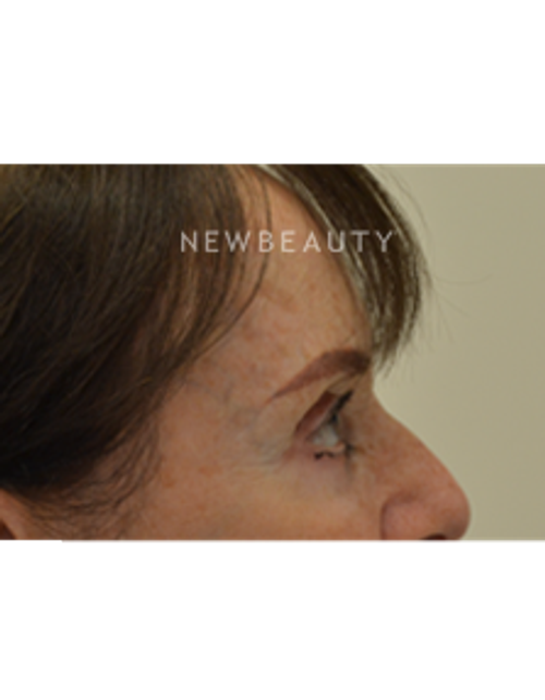 Dr. Julie Russak - Liquid Facelift - After