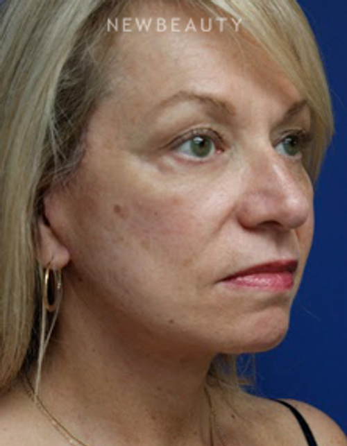 Dr. Joseph Russo - Rejuvenated Look (Face EBG) - After