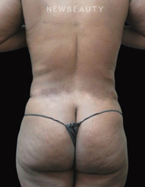 Dr. Elie Levine - Liposuction - After