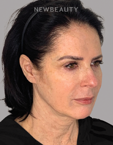Dr. Dilip Madnani - Facelift -  45284120 - Before