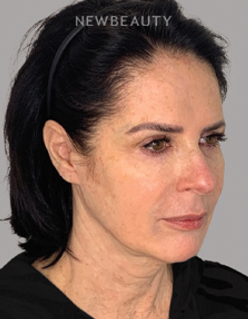 Dr. Dilip Madnani - Facelift -  45284120 - Before