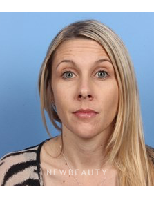 Dr. Kelly Bomer - Dysport - Before