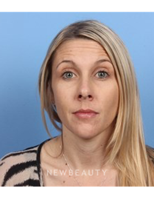 Dr. Kelly Bomer - Dysport - Before