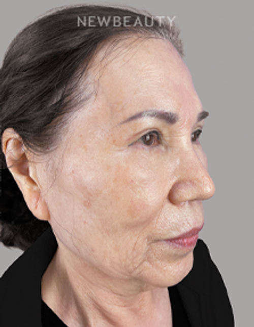 Dr. Sheila Barbarino-Blepharoplasty-5479898 - After