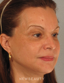 Dr. Henry Mentz Eye Lift, Facelift, Necklift - After