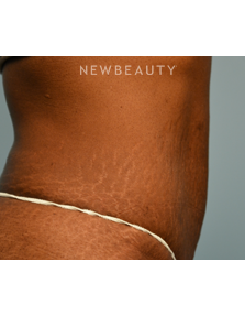 Dr. Ruth Hillelson - Thermage - After