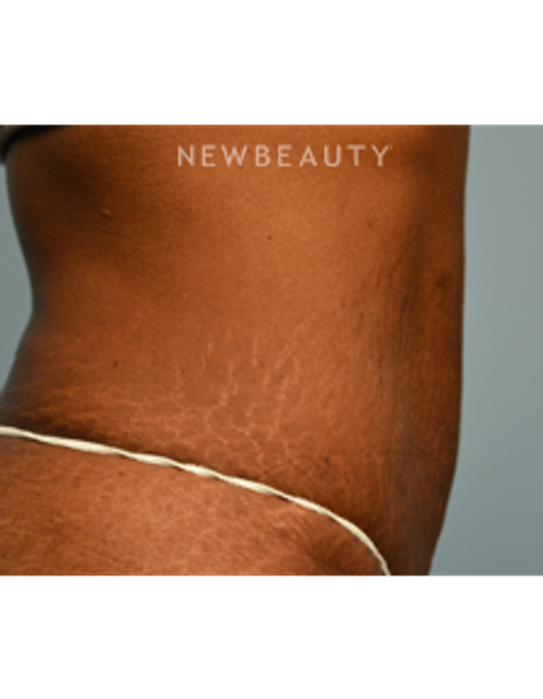 Dr. Ruth Hillelson - Thermage - After
