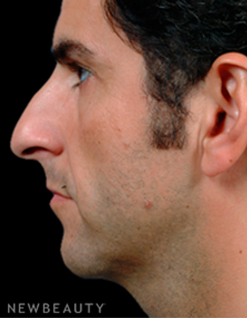 Dr. Steven Bloch Rhinoplasty - Before