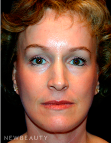 Dr. Kelly Bomer Facelift - After