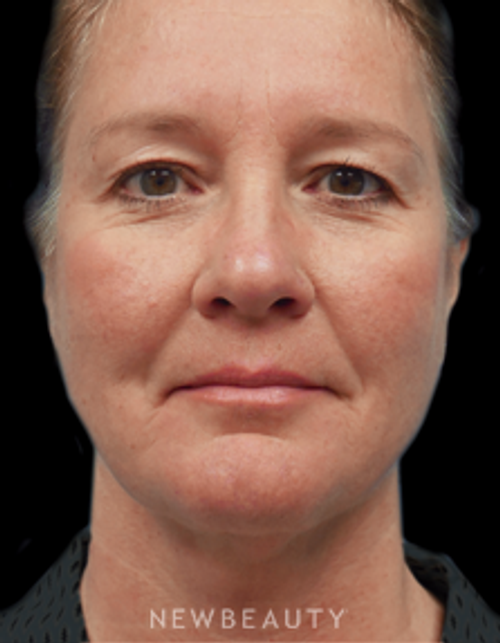 Dr. Christine Hamori - Necklift - After