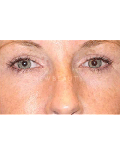 Dr. Phillip Chang Eyelift - After