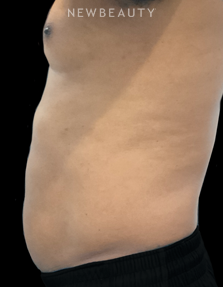 Dr. Janet Allenby - CoolTone - After