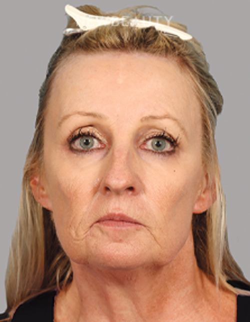 Dr. Mahabir - Facelift - 20637984 - Before