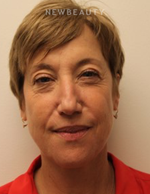 Dr. Kimberly Lee- Lasers - Before
