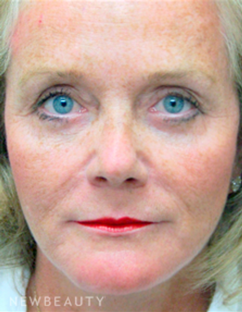 Dr. Mokhtar Asaadi Facelift - After