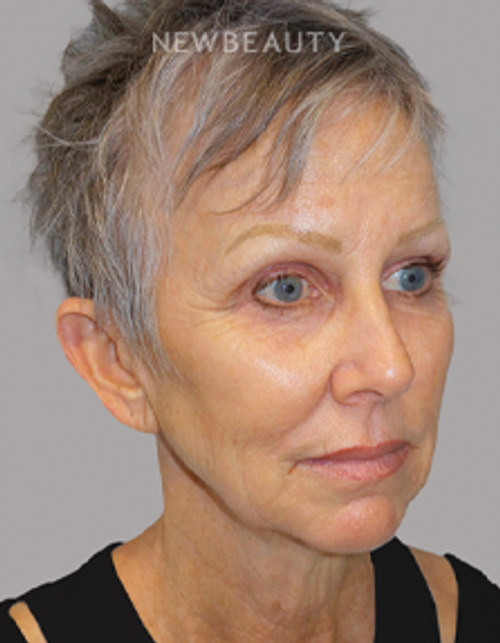 Dr. Sanjay Grover - Facelift - 49726567 - Before
