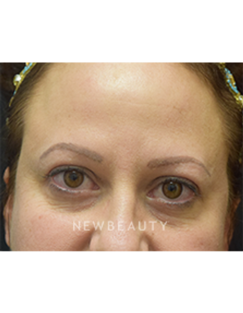Dr. Jeffrey B. Wise - Upper Blepharoplasty - After